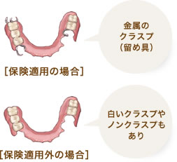 部分入れ歯：保険適用と適用外の場合