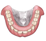 金属床義歯イメージ